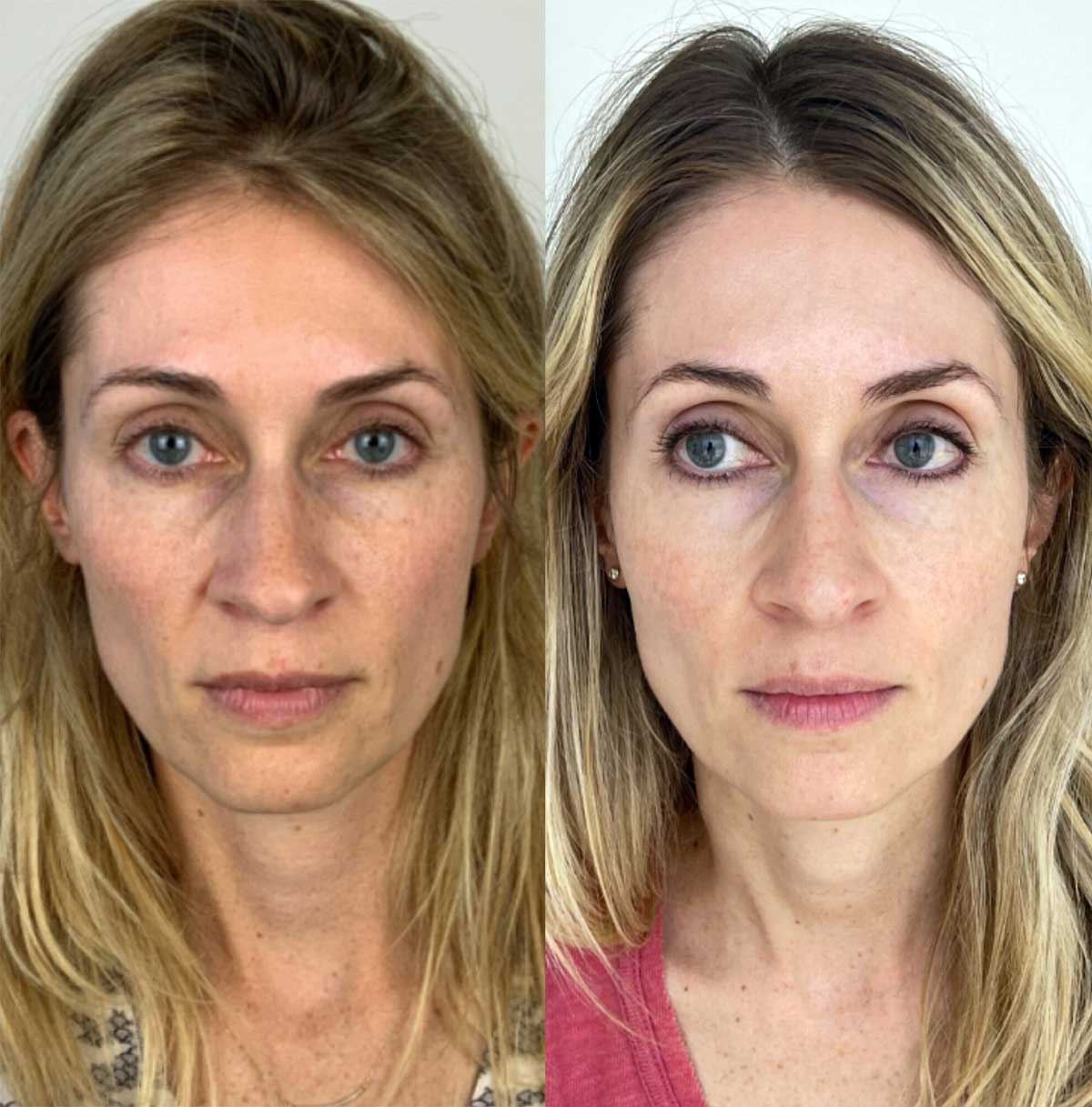 Sculptra-Treatment